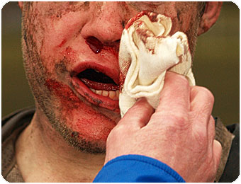 blood_nose.jpg