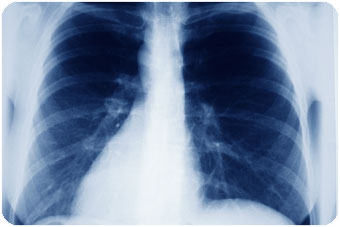 X-ray-lungs-chest.jpg