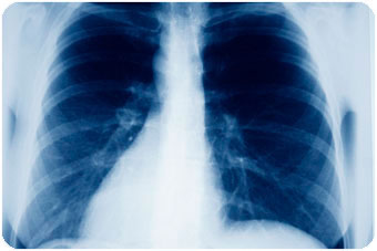 x-ray-lungs.jpg